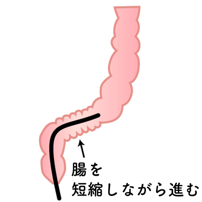 大腸の状態　腸を短縮しながら進む